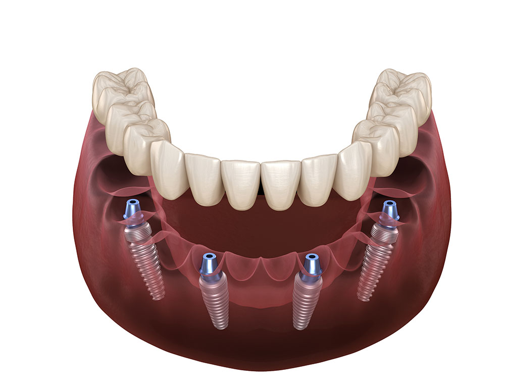 Mandibular prosthesis All on 4 system supported by implants. Med